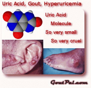 Uric Acid, Gout & Hyperuricemia image