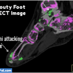 Gouty Foot DECT Image