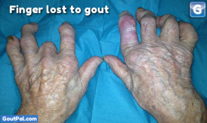 Gouty Fingers Photo