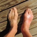 Skin Discoloration of Gouty Foot photo