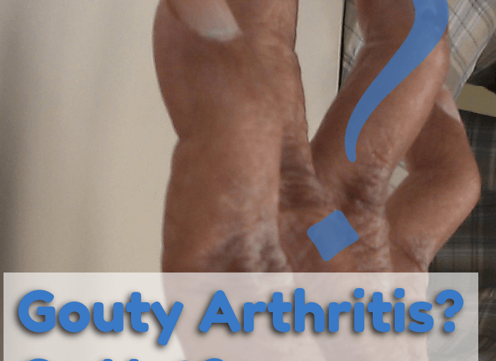 Gouty Arthritis Or Not photo