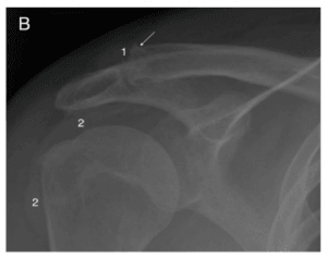 Gout in Shoulder X-ray image