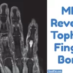 Gouty Tophi In Finger Bone